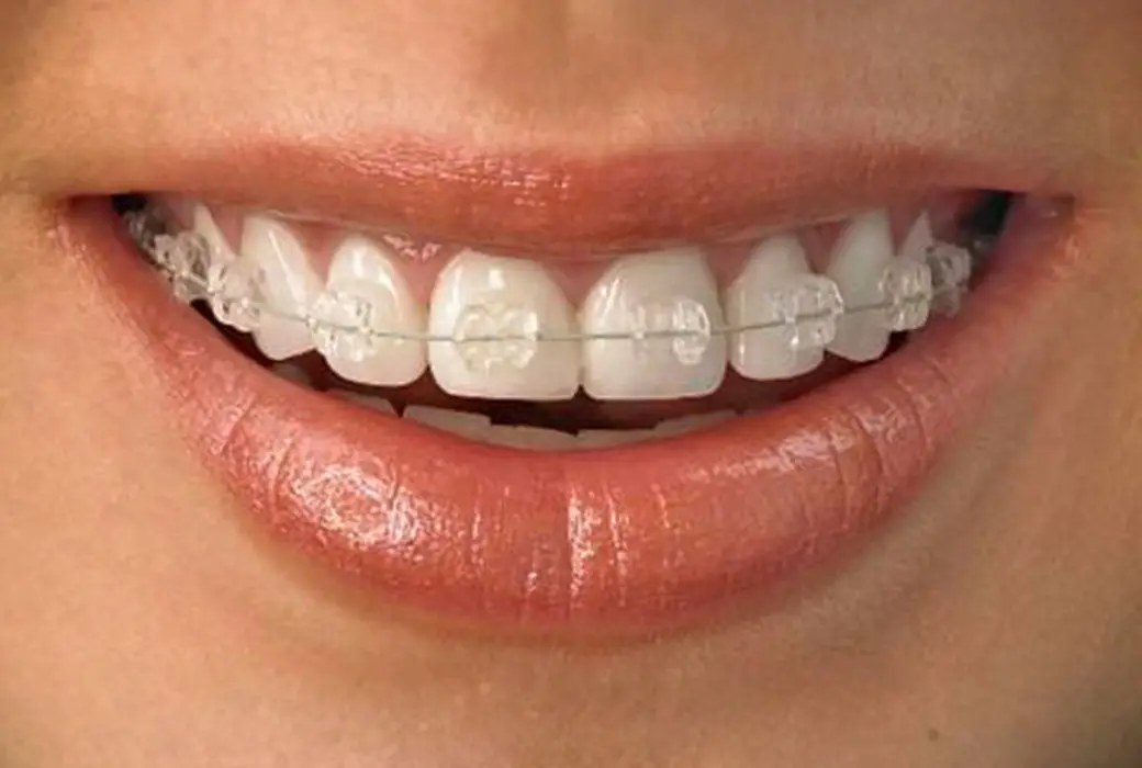 Bagues en céramique auto-ligaturantes, discrètes et de la teinte des dents