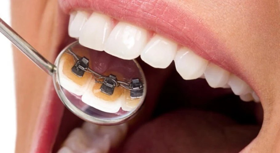 Appareil d'orthodontie linguale — bagues fixées sur la face interne des dents, invisibles de l'extérieur