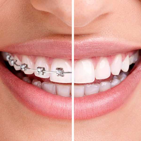 Appareil multi-bagues vestibulaire métallique — avant/après alignement des dents