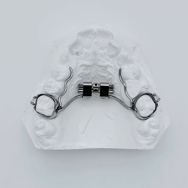 Disjoncteur orthodontique : deux bagues fixées sur les molaires supérieures et reliées par un vérin médian, sur modèle en plâtre